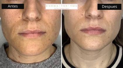 Limpieza Facial Profunda, peeling, yoga facial, acné, manchas y más.