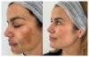 Limpieza Facial Profunda, peeling, yoga facial, acné, manchas y más.